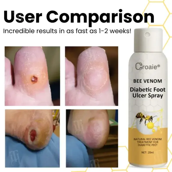 Bee Venom Diabetic Foot Ulcer Spray