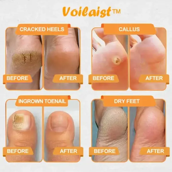 Bee Venom Lymphatic Drainage & Slimming Foot SoakBeads