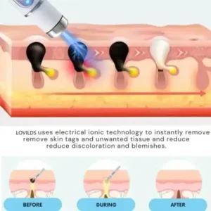 Non-Invasive Mole and Wart Removal Laser Pen