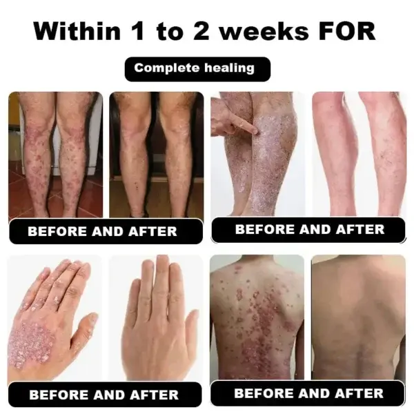 Psoriasis Cure Cream