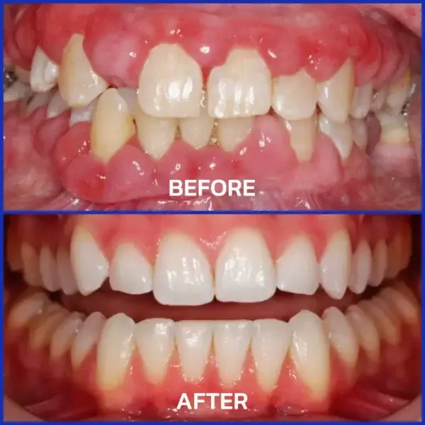 VioGloss Bienengift-Zahntherapie Oral Power