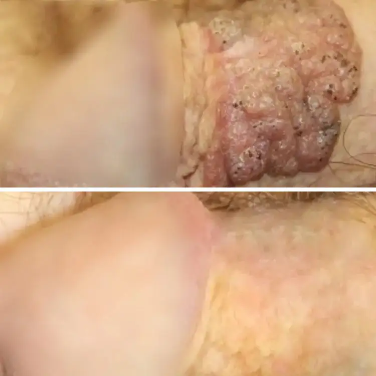 |Genital Warts Remover Cream for Men - Image 8
