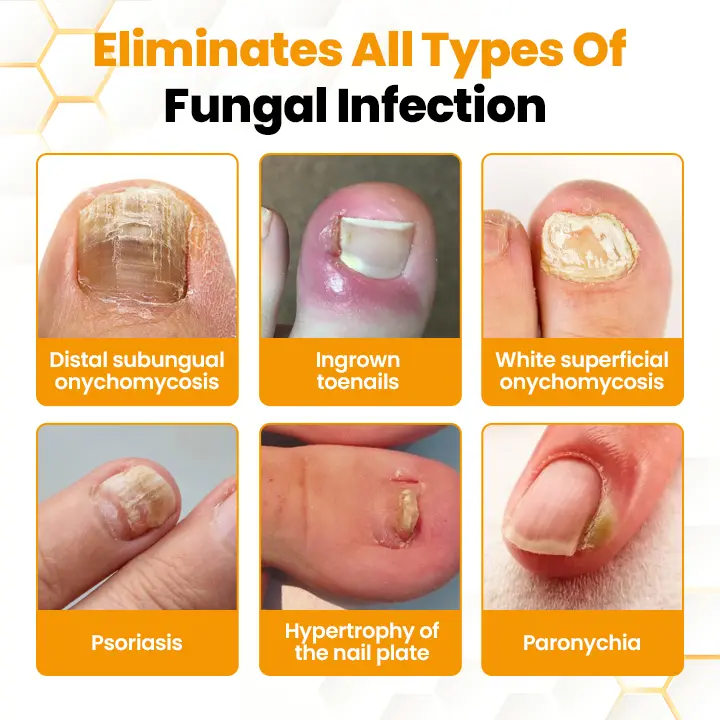 BeeVenom Anti-Fungal Nail Renewal Oil - Image 3