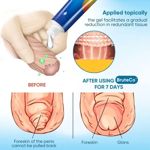 Redundant Prepuce Corrector Gel - Image 5