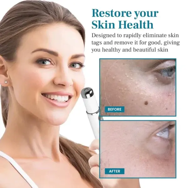 DAFEILA® LumeSkin Mole and Wart Removal Laser Pen - Image 6