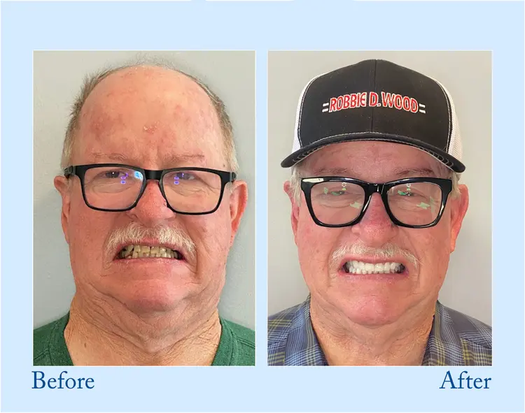 Custom-Fit Functional Dentures - Image 15