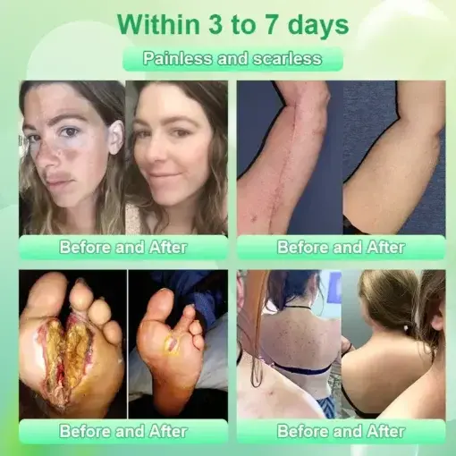 Purifying Exfoliating Gel for Acanthosis Nigricans - Image 4