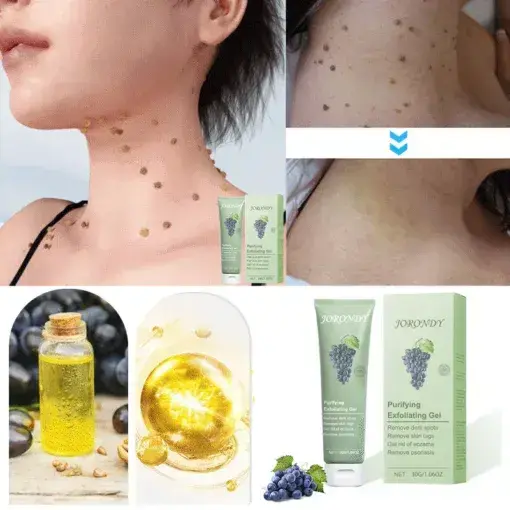 Purifying Exfoliating Gel for Acanthosis Nigricans - Image 9