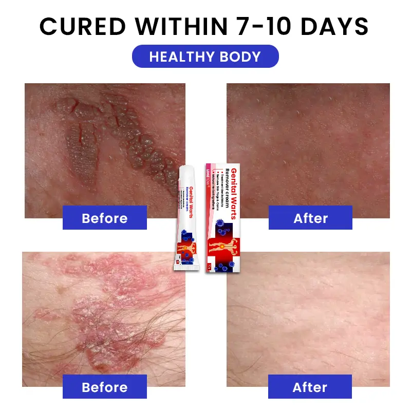 Genital Warts Remover Cream - Image 8