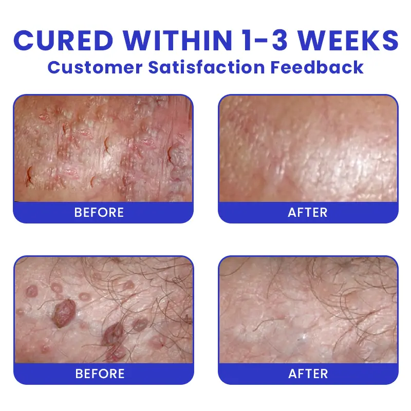 Genital Warts Remover Cream - Image 9