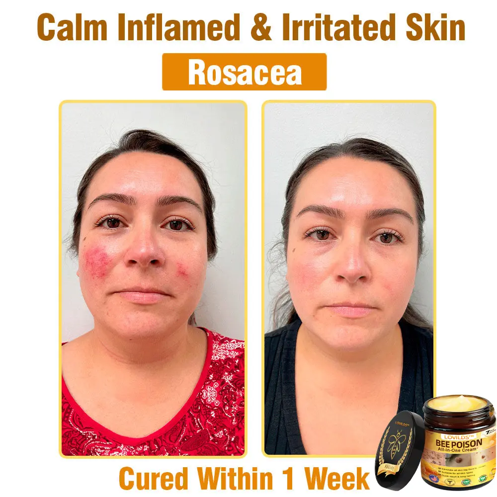 Bee Poison All-in-One Cream US Dermatologist Approved - Image 5