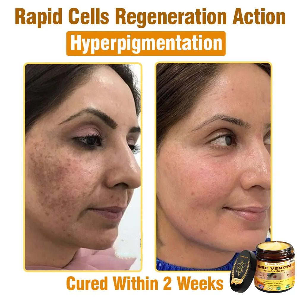 Bee Venom All-in-One Cream US Dermatologist Approved - Image 8
