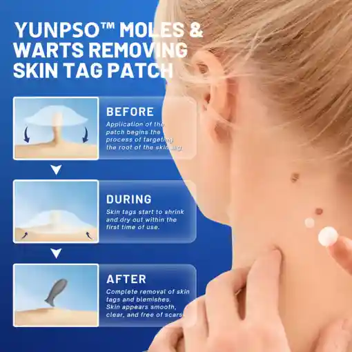 Moles & Warts Removing Skin Tag Patch
