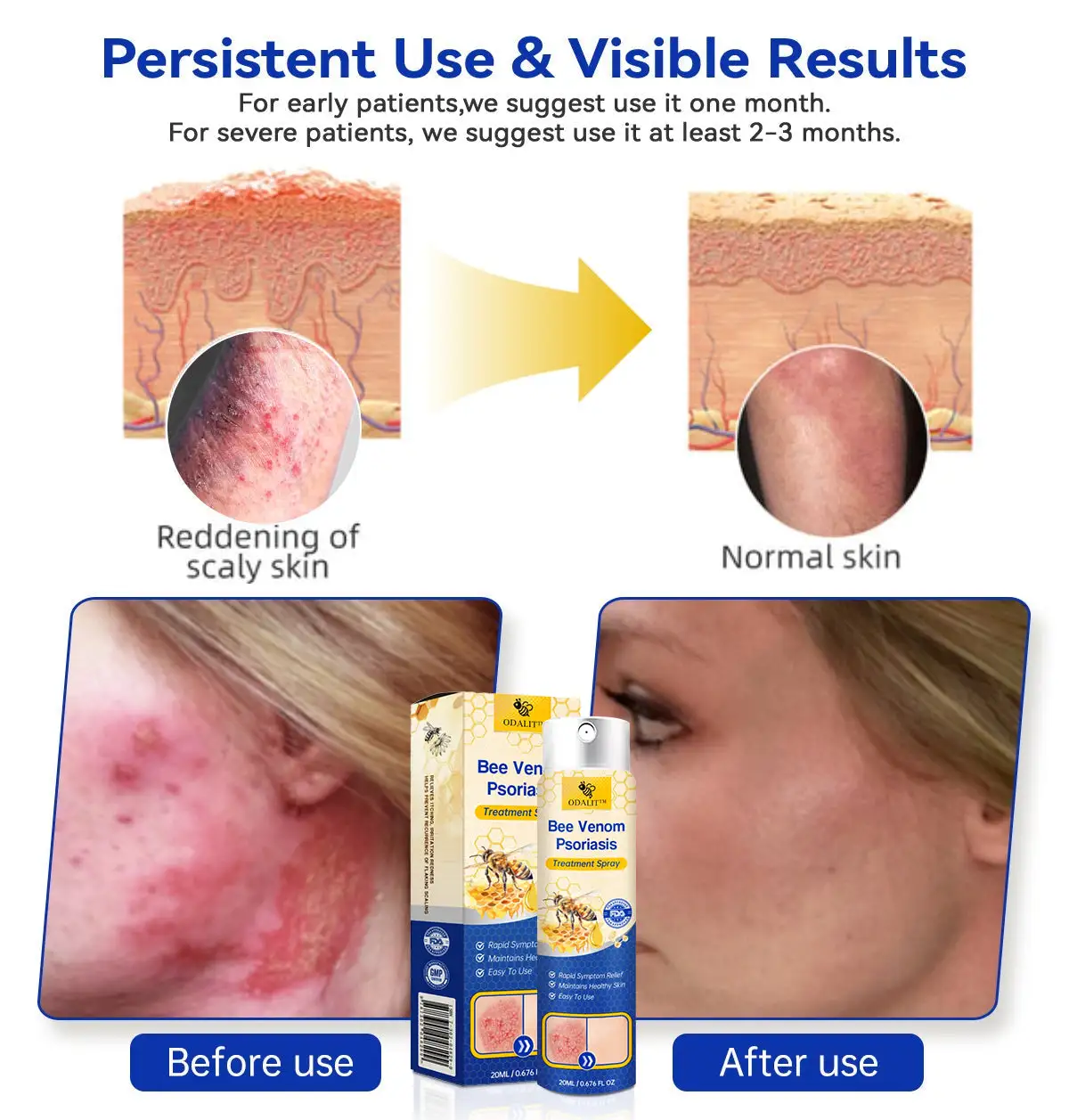 PsoriaHeal psoriasis Spray - Image 3