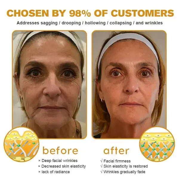 Special Discount Botox Bee Venom Wrinkle Removal Cream - Image 4