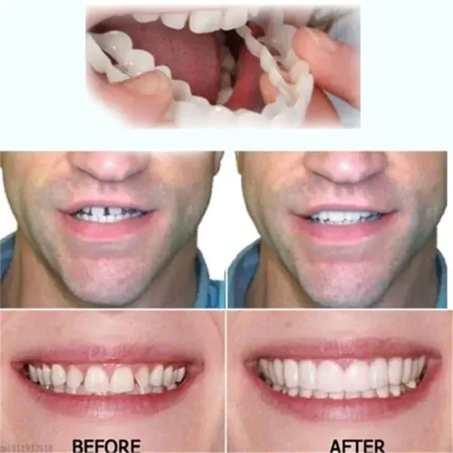 Adjustable Snap-On Dentures - Image 8
