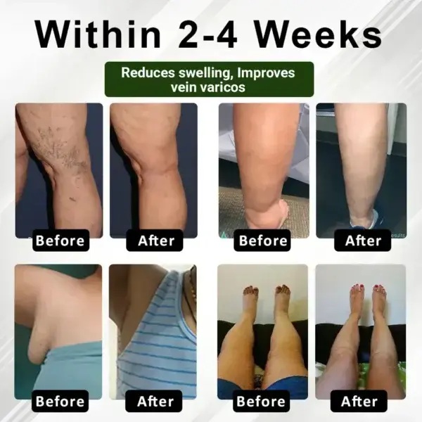 FluidEase Leg Therapy Edema Cream - Image 6