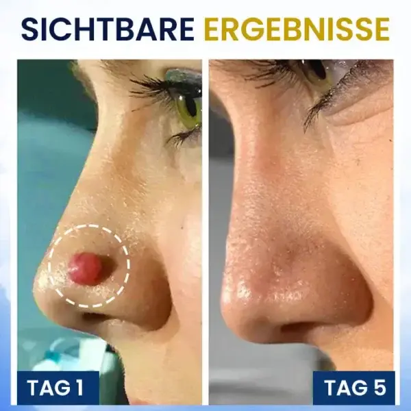 Hautanhängsel-Kryo-Behandlungsspray - Image 7