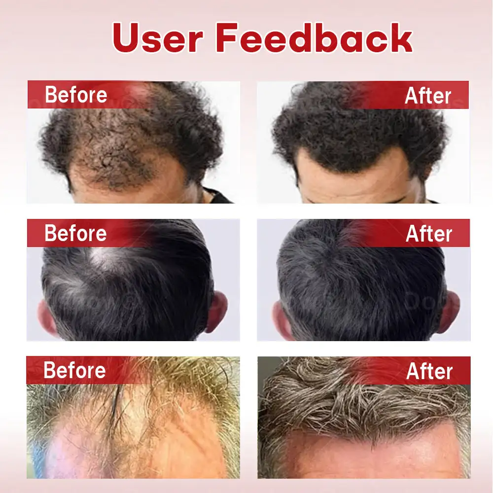 Hair Regrowth System - Image 3