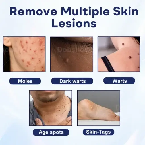 Mole and Wart Removal Cream - Image 3