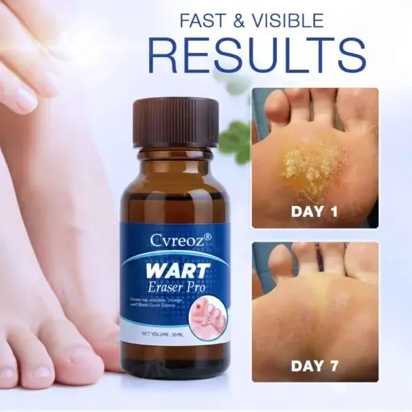 Wart Eraser Pro - Image 2
