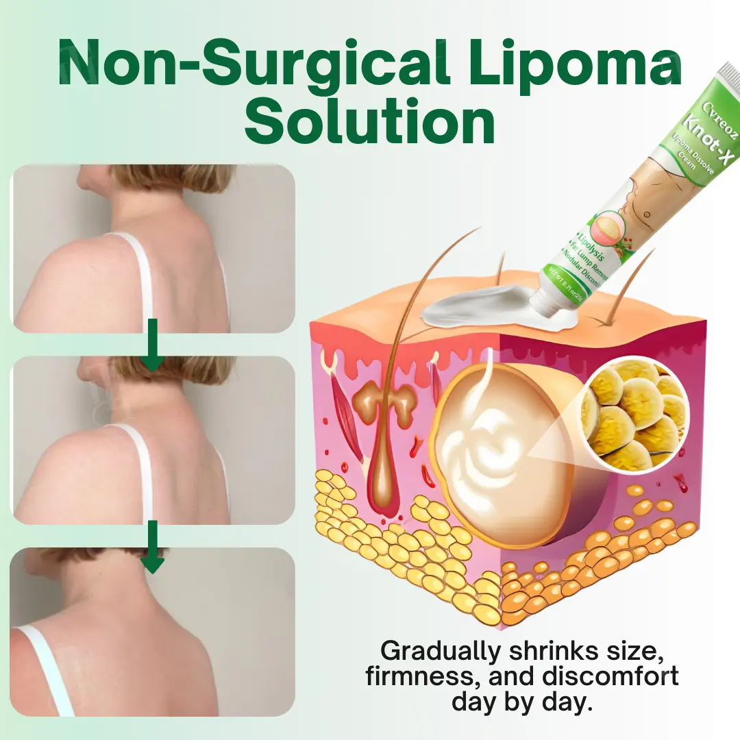 Knot-X Lipoma Dissolve Cream - Image 6
