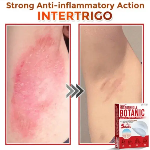 Removal Patch: Gentle Microneedle Patches for Skin Tag & Mole Removal - Image 8