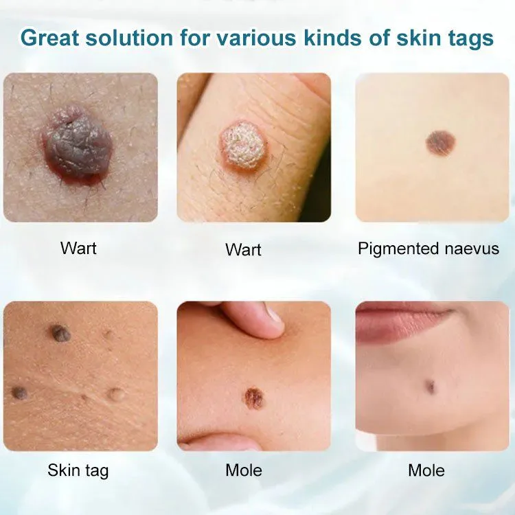 Concentrated potent skin tag removal cream - Image 3