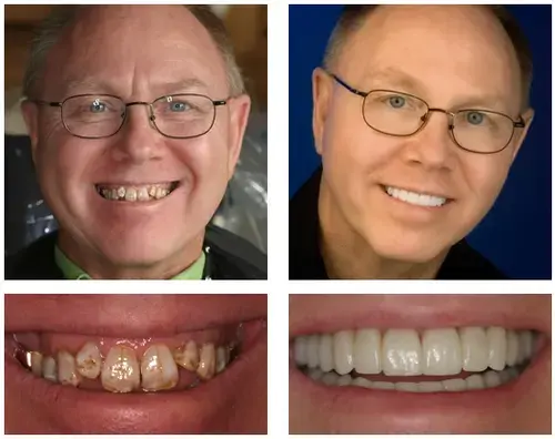 Custom-Fit Functional Dentures Smile with Confidence - Image 6