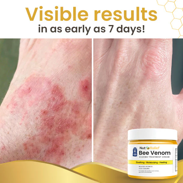 Bee Venom Eczema Treatment Cream - Image 5