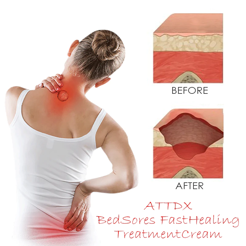 ATTDX BedSores FastHealing TreatmentCream - Image 2