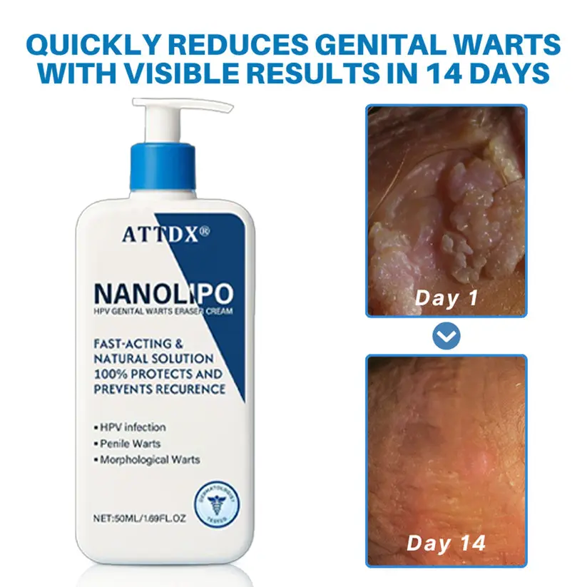 NanoLipo HPV Genital Warts Eraser Cream - Image 2