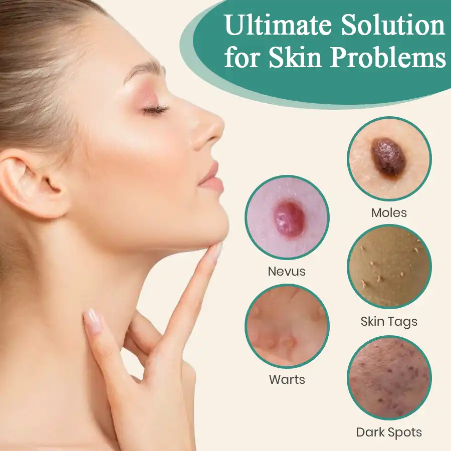 LumeSkin Mole and Wart Instant Removal Laser Pen ACE 4 - Image 3