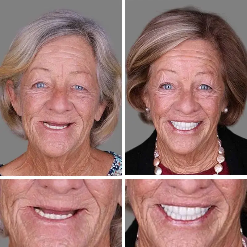 Advanced Customized Full Denture Set - Image 10