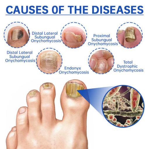 Advanced PureNail Fungus Laser Device - Image 7