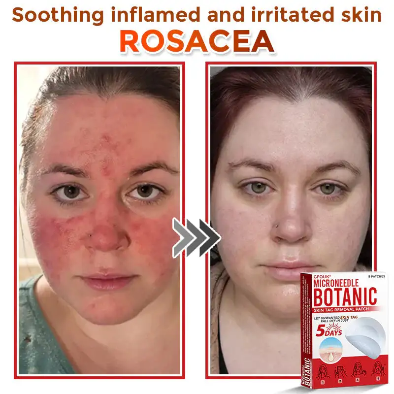 MicroNeedle Botanic Skin Tag Removal Patch - Image 5