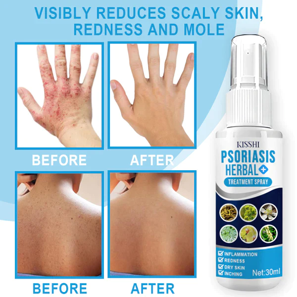 Psoriasis Herbal Treatment Spray - Image 4