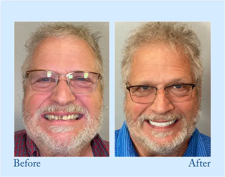 Custom-Fit Functional Dentures - Perfectly Fitted in Minutes at Home - Image 7