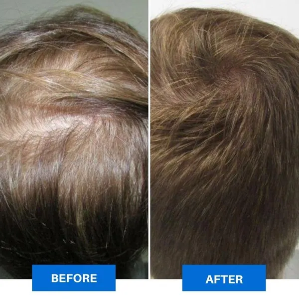- Smart Scalp Massager - Image 5