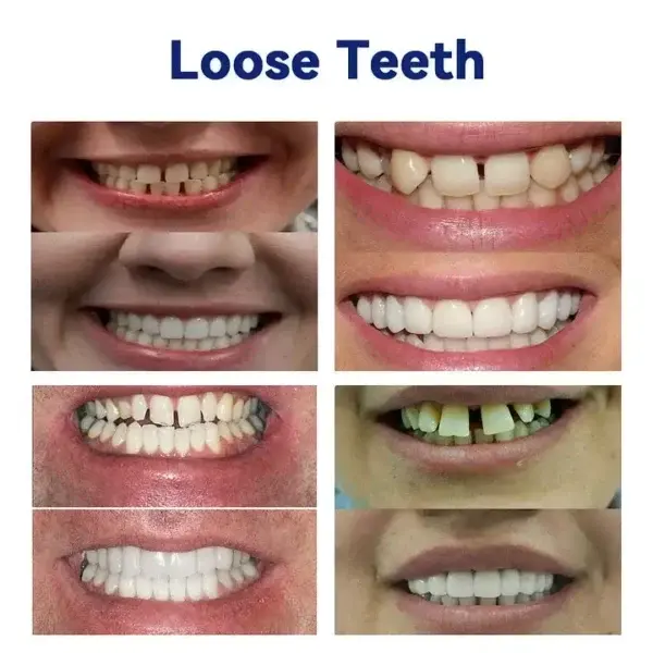 New Generation Flexible Full Denture Solution - Image 6