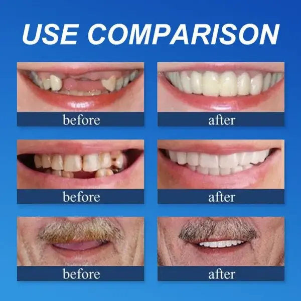 Advanced Customized Full Denture Set - Image 10