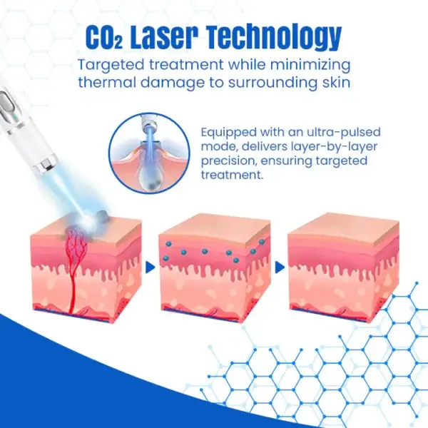 DermZap Mole & Wart Removal Laser Pen - Image 4
