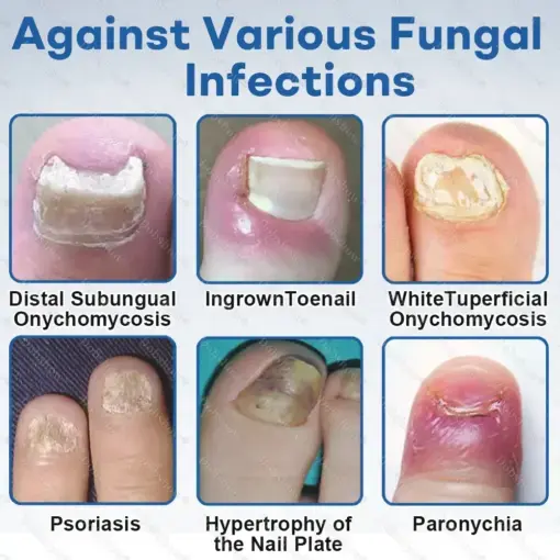 Nano Rapid Clear Nail Fungus Rapair Liquid Effective in Seven Days, Permanently Eliminates the Root - Image 8