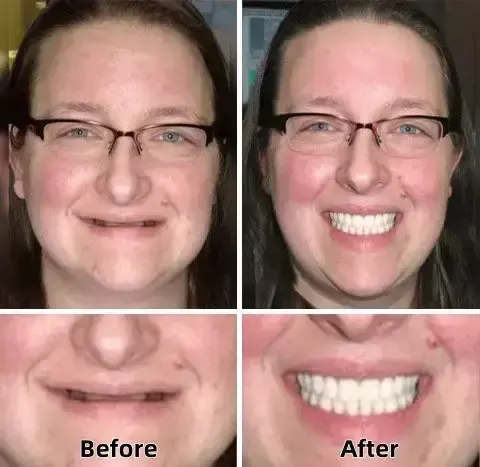 –Advanced Custom-Fit Functional Dentures - Image 4