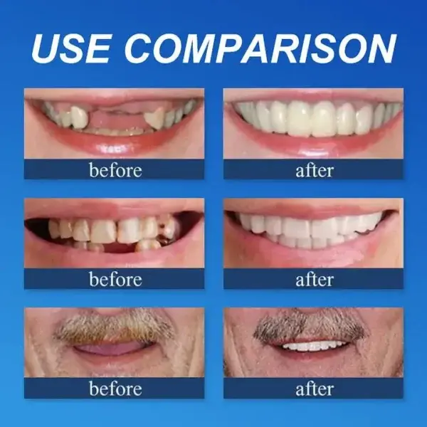 Medical Full Denture with Strong Suctiond - Image 7