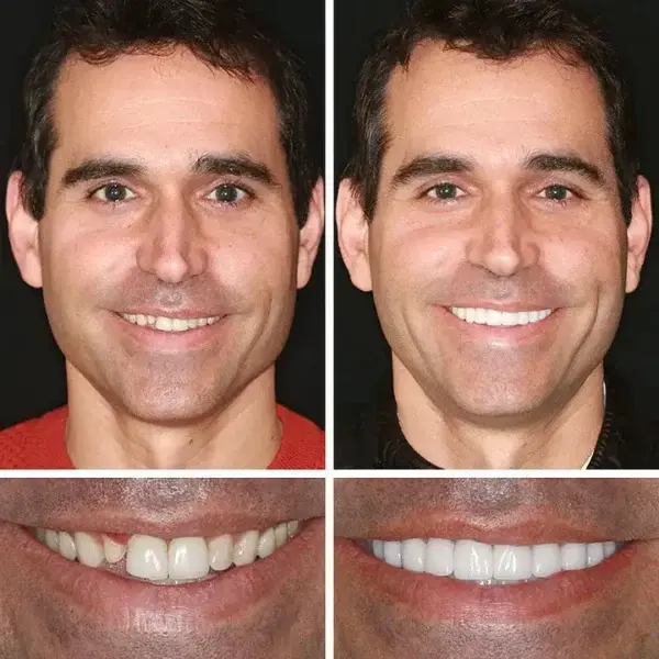 – Medical Full Denture with Strong Suctiond - Image 9