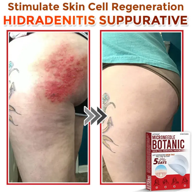 MicroNeedle Botanic Skin Tag Removal Patch - Image 11