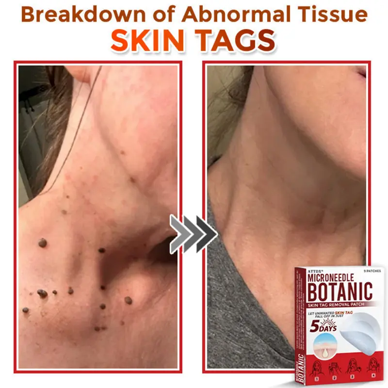 MicroNeedle Botanic Skin Tag Removal Patch - Image 5