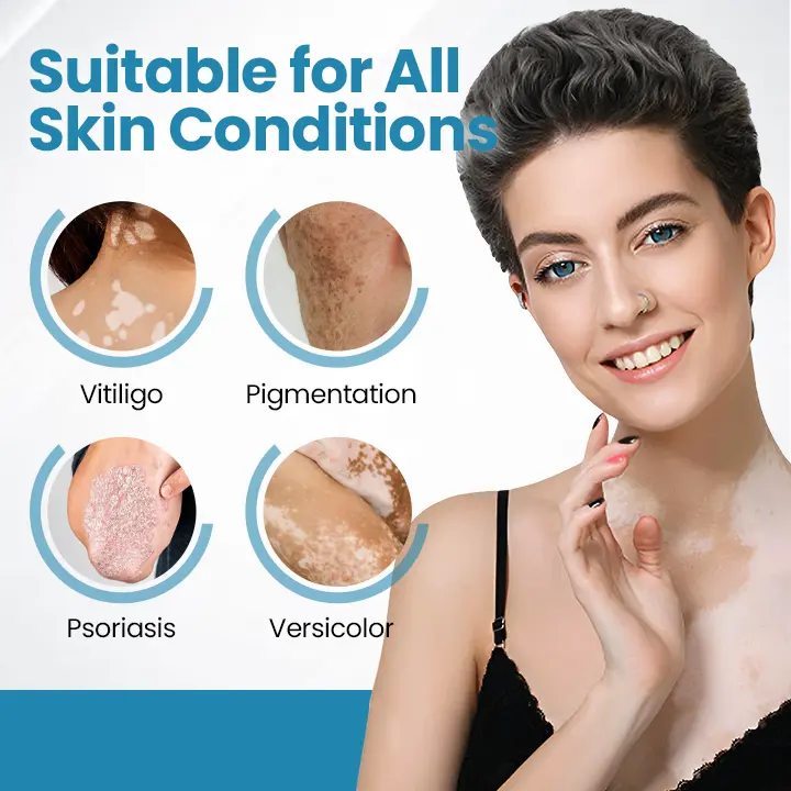 DermaBeam Vitiligo Therapy Device - Image 2