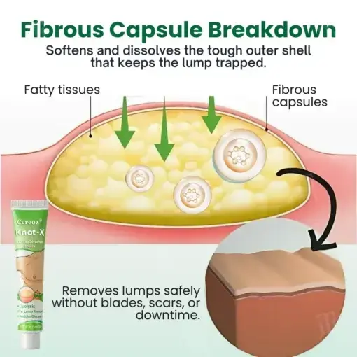 Knot-X Lipoma Dissolve Cream - Image 5
